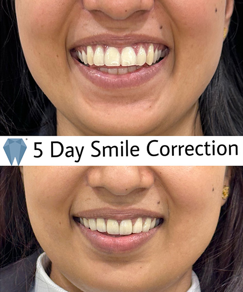 Expressio 5 Days Smile