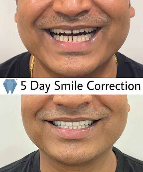 Expressio 5 Days Smile