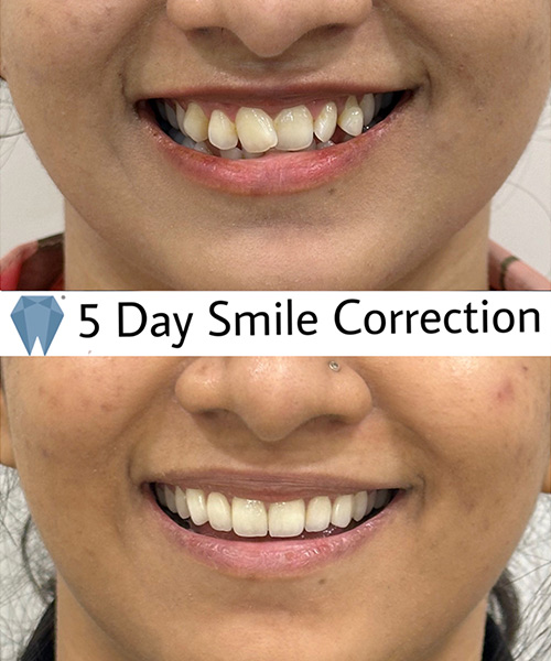 Expressio 5 Days Smile