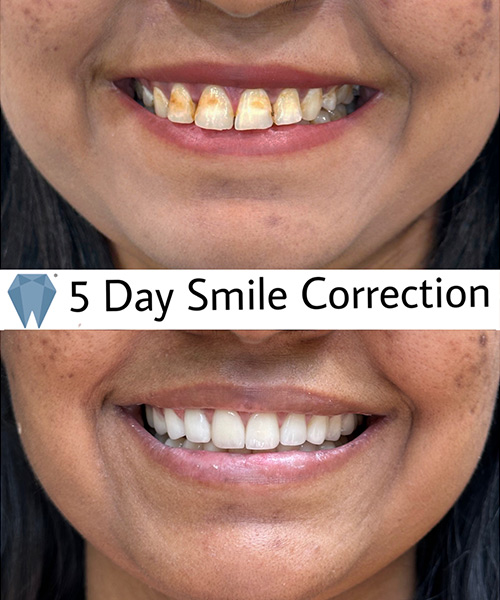 Expressio 5 Days Smile