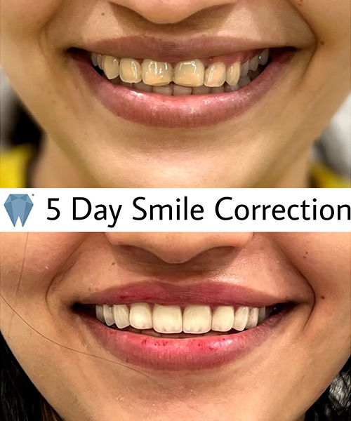 Expressio 5 Days Smile