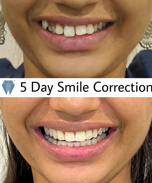 Expressio 5 Days Smile