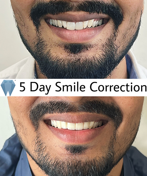 Expressio 5 Days Smile