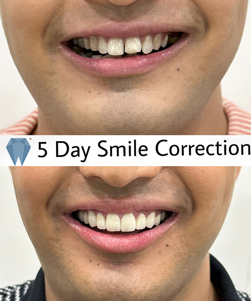 Expressio 5 Days Smile