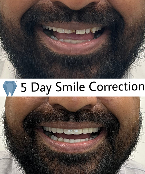 Expressio 5 Days Smile