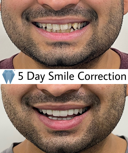 Expressio 5 Days Smile